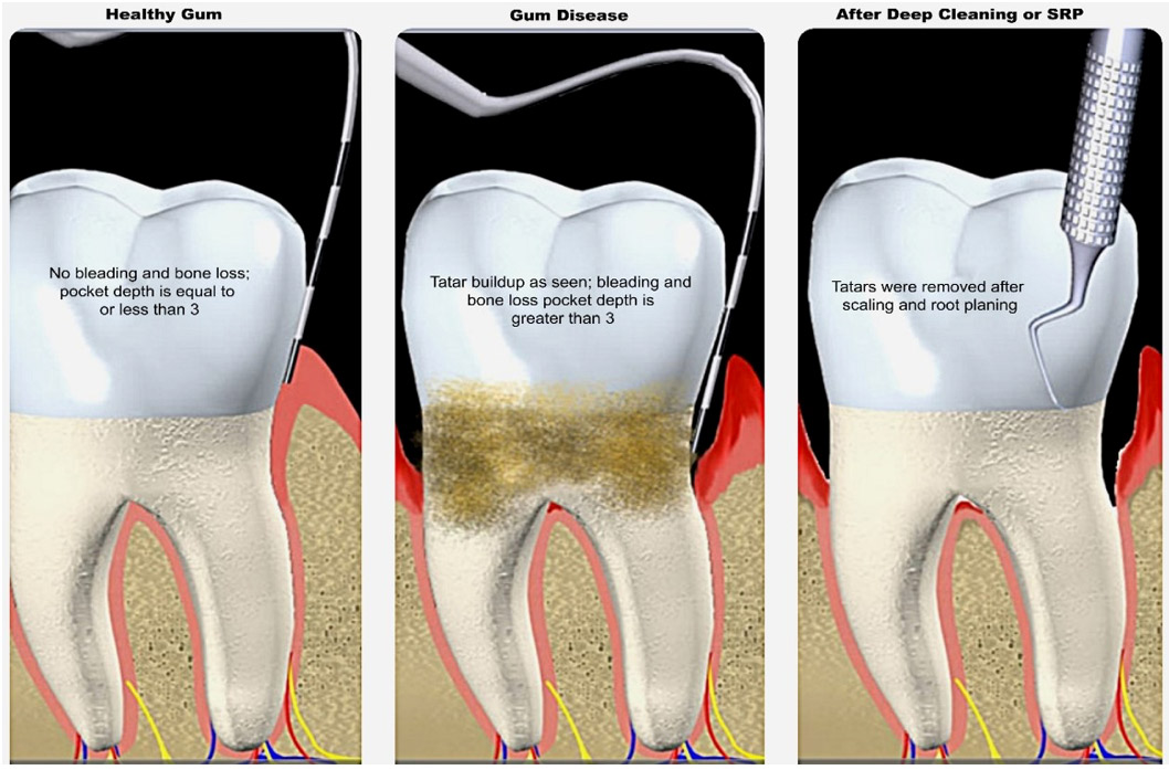 The disadvantages of deep cleaning teeth your teeth weekly